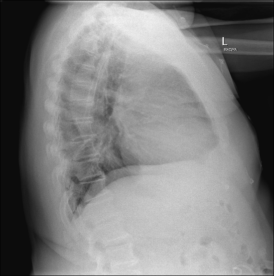 Signs and Symptoms of Primary Hyperparathyroidism